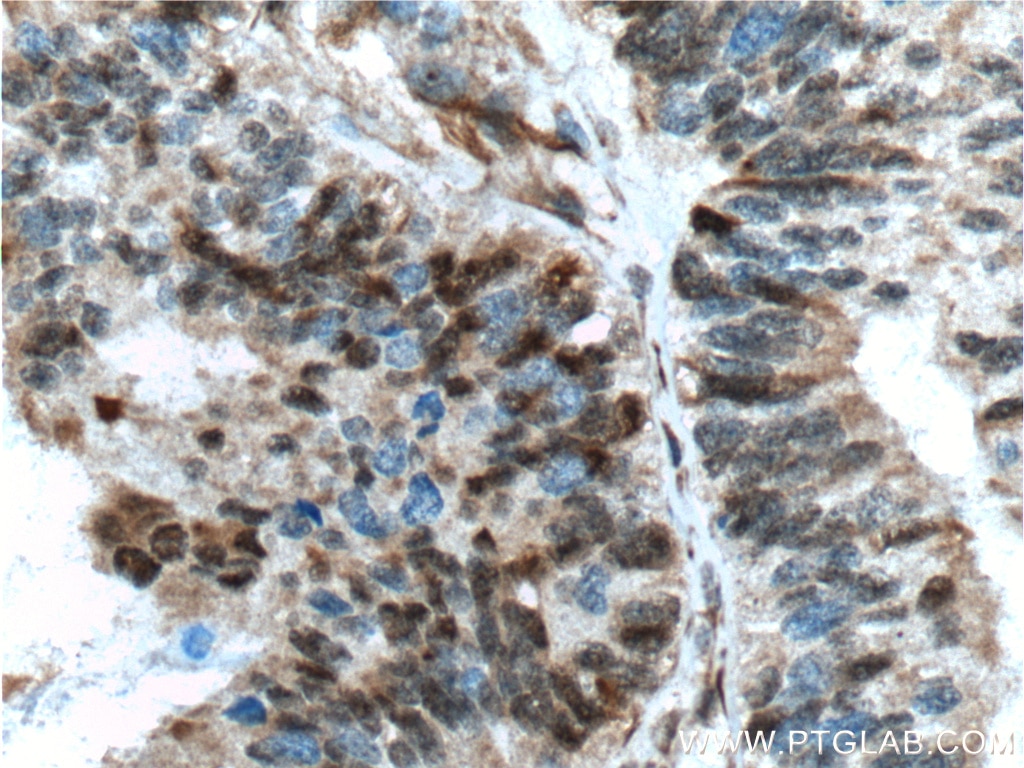 IHC staining of human ovary tumor using 26714-1-AP