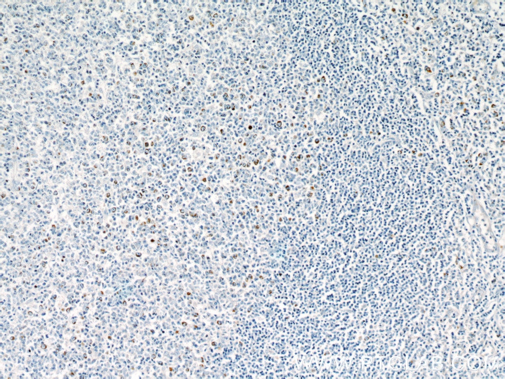 Immunohistochemistry (IHC) staining of human tonsillitis tissue using P2RX7 Polyclonal antibody (11144-1-AP)