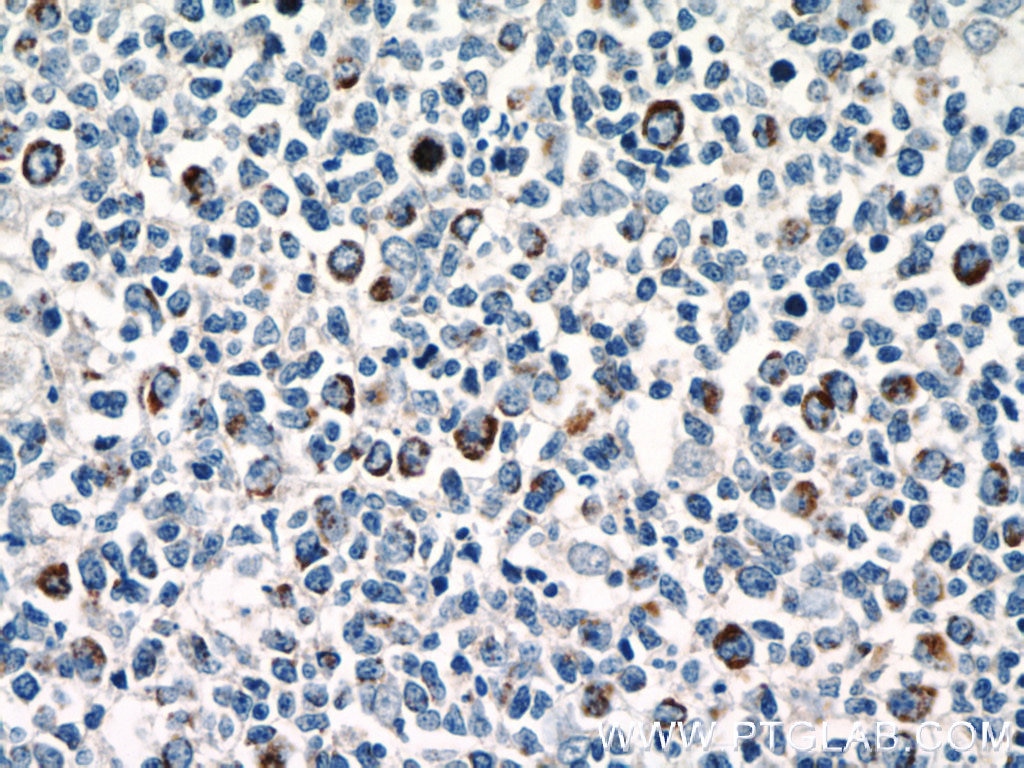 Immunohistochemistry (IHC) staining of human tonsillitis tissue using P2RX7 Polyclonal antibody (11144-1-AP)