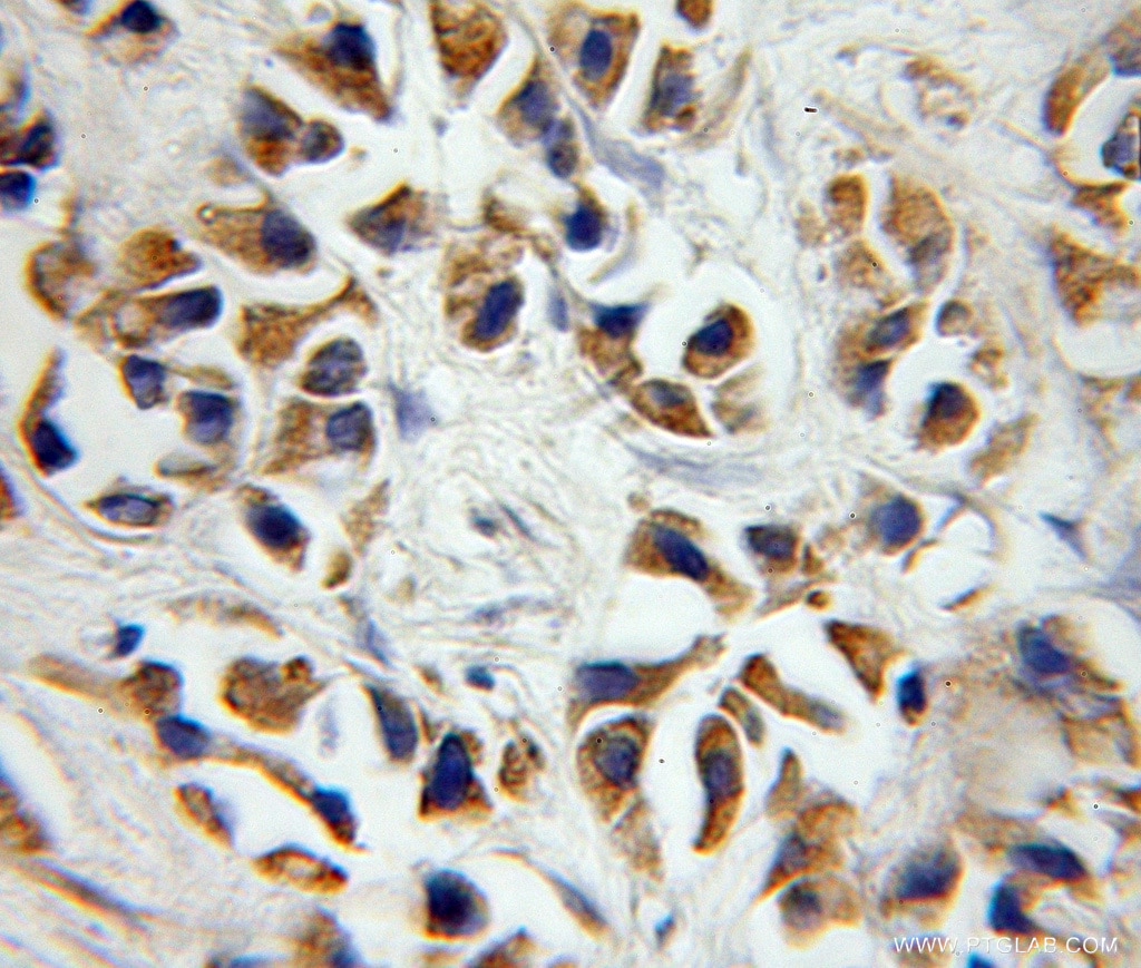 Immunohistochemistry (IHC) staining of human prostate cancer tissue using P2RX7 Polyclonal antibody (11144-1-AP)