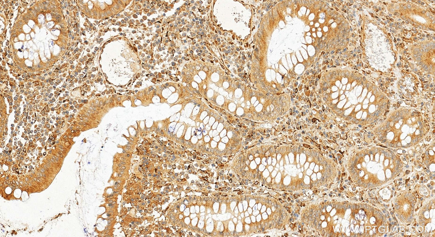 Immunohistochemistry (IHC) staining of human colon cancer tissue using P4HA1 Polyclonal antibody (12658-1-AP)