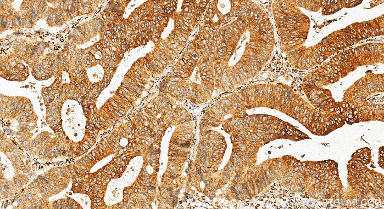 Immunohistochemistry (IHC) staining of human colon cancer tissue using P4HA1 Polyclonal antibody (12658-1-AP)