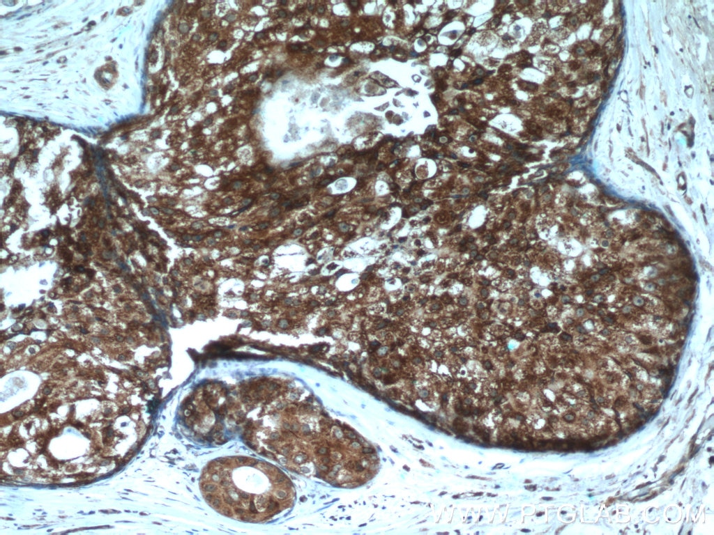 Immunohistochemistry (IHC) staining of human breast cancer tissue using P4HA1 Polyclonal antibody (12658-1-AP)