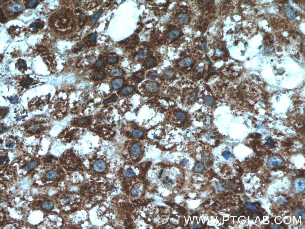 Immunohistochemistry (IHC) staining of human breast cancer tissue using P4HA1 Polyclonal antibody (12658-1-AP)