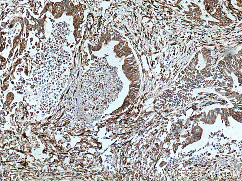 Immunohistochemistry (IHC) staining of human pancreas cancer tissue using P4HA1 Polyclonal antibody (12658-1-AP)