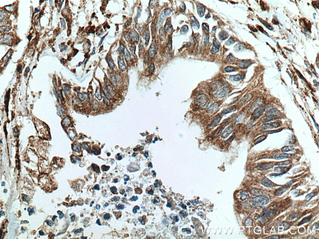 IHC staining of human pancreas cancer using 12658-1-AP