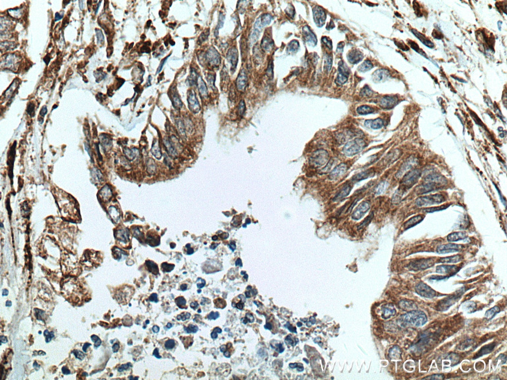 Immunohistochemistry (IHC) staining of human pancreas cancer tissue using P4HA1 Polyclonal antibody (12658-1-AP)