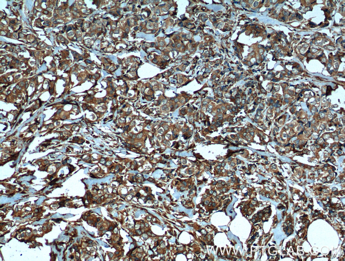 Immunohistochemistry (IHC) staining of human breast cancer tissue using P4HA1 Monoclonal antibody (66101-1-Ig)