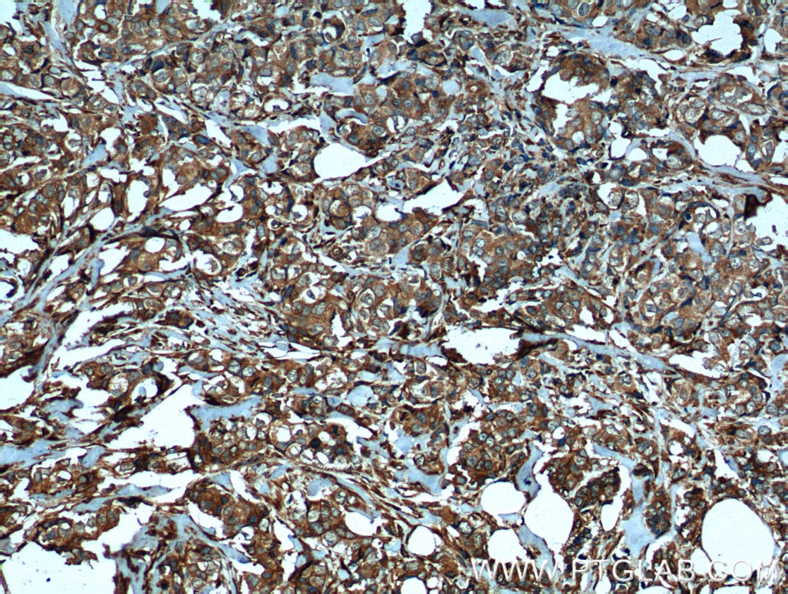 IHC staining of human breast cancer using 66101-1-Ig