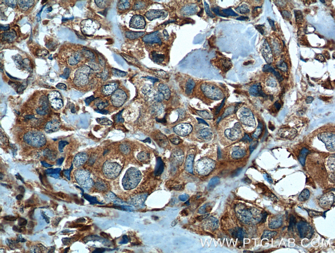 IHC staining of human breast cancer using 66101-1-Ig