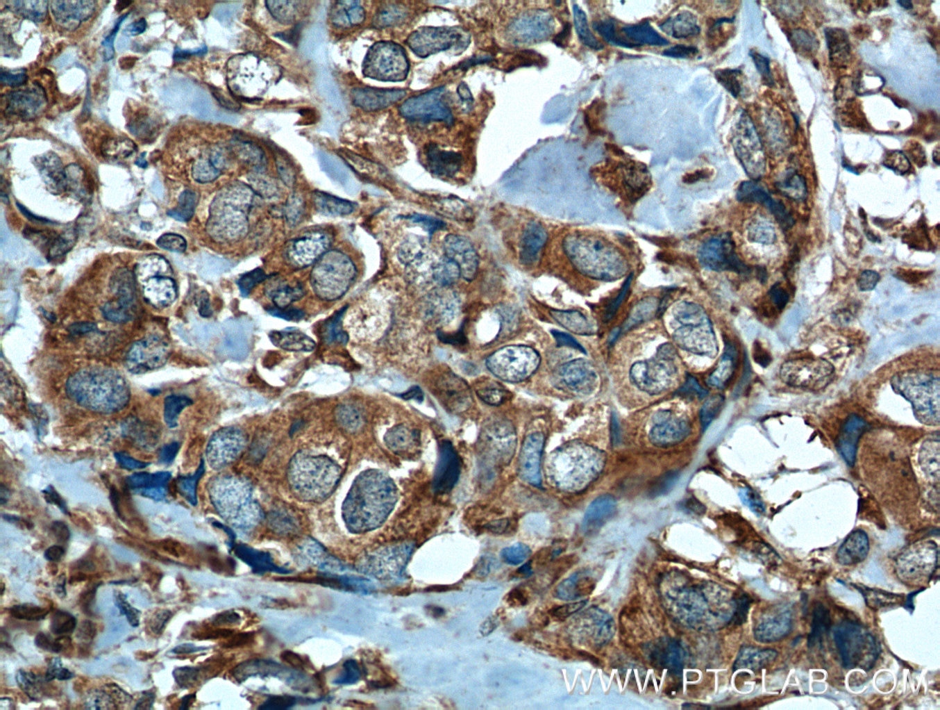 Immunohistochemistry (IHC) staining of human breast cancer tissue using P4HA1 Monoclonal antibody (66101-1-Ig)