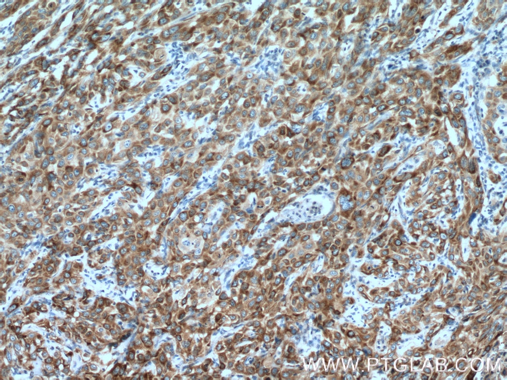 Immunohistochemistry (IHC) staining of human cervical cancer tissue using P4HA2 Polyclonal antibody (13759-1-AP)