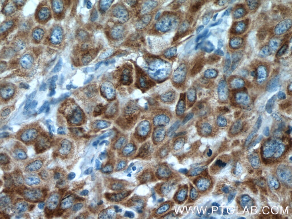 Immunohistochemistry (IHC) staining of human cervical cancer tissue using P4HA2 Polyclonal antibody (13759-1-AP)
