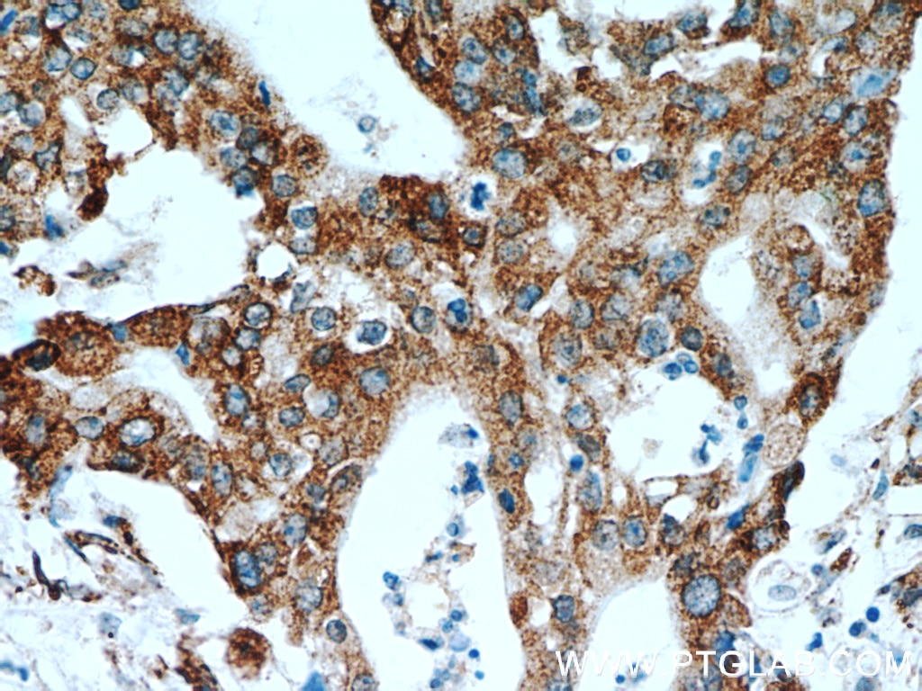 IHC staining of human pancreas cancer using 13759-1-AP