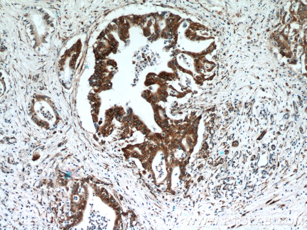 IHC staining of human pancreas cancer using 13759-1-AP