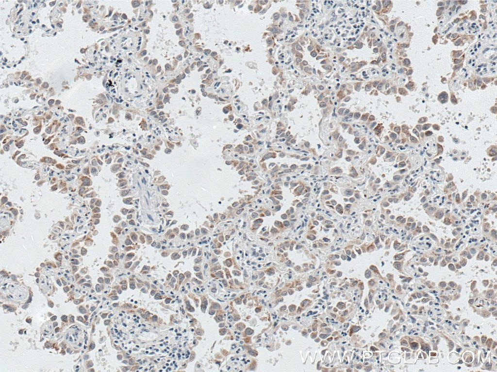 Immunohistochemistry (IHC) staining of human lung cancer tissue using P4HA2 Monoclonal antibody (66604-1-Ig)