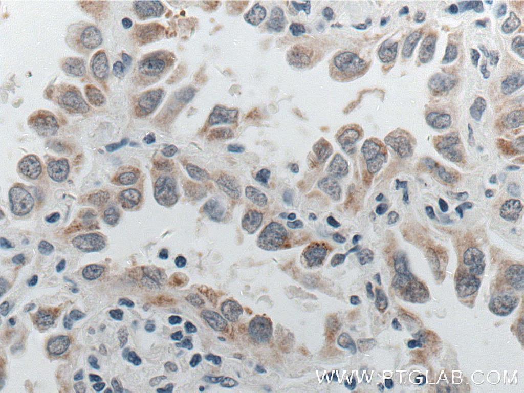 Immunohistochemistry (IHC) staining of human lung cancer tissue using P4HA2 Monoclonal antibody (66604-1-Ig)