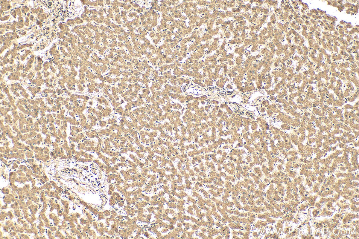 Immunohistochemical analysis of paraffin-embedded human liver tissue slide using 23185-1-AP (P4HA3 antibody) at dilution of 1:100 (under 10x lens). Heat mediated antigen retrieval with Tris-EDTA buffer (pH 9.0). Immunohistochemistry (IHC) staining of human liver tissue using P4HA3 Polyclonal antibody (23185-1-AP)