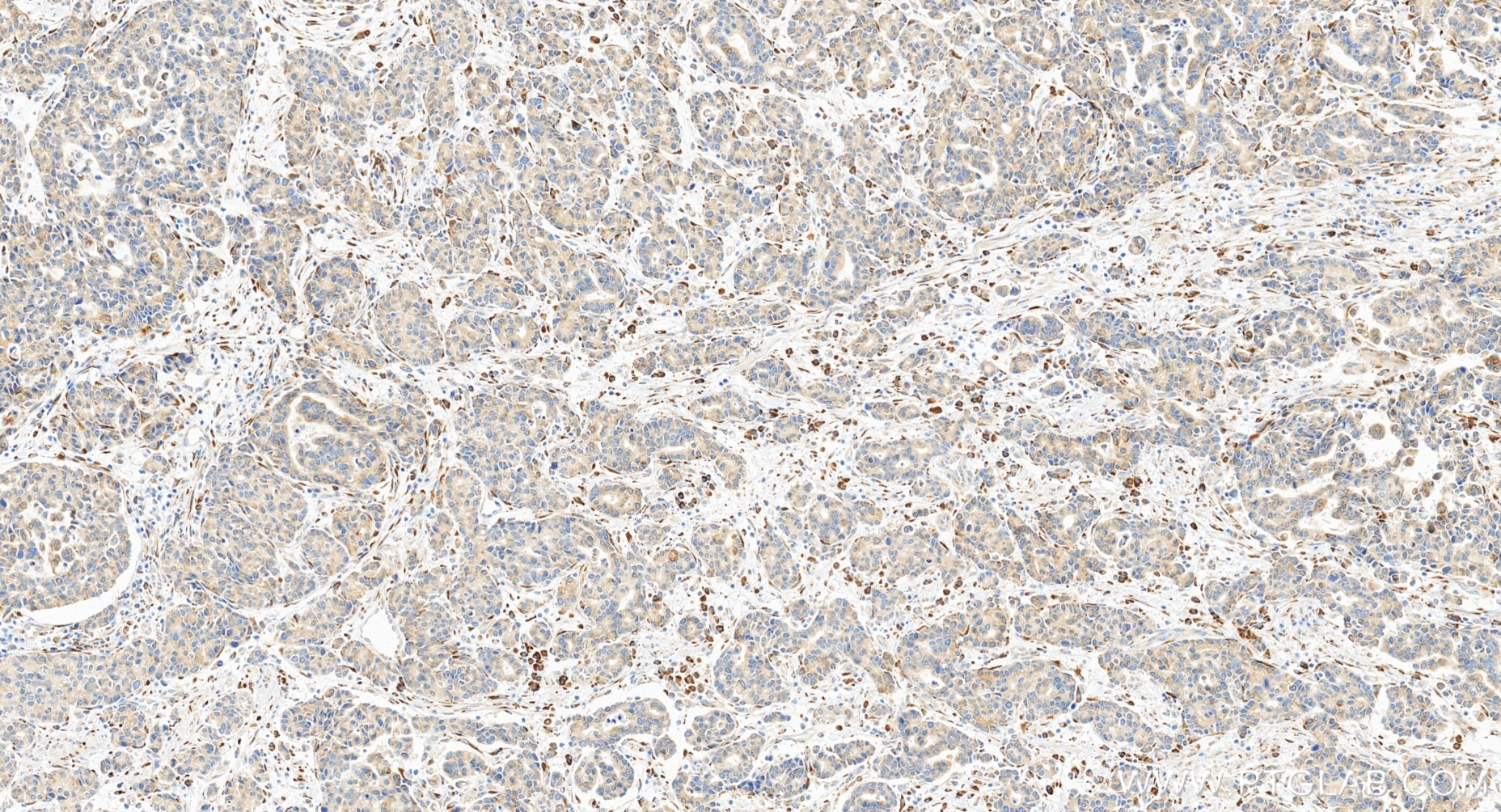 Immunohistochemical analysis of paraffin-embedded human stomach cancer tissue slide using 85374-1-RR (P4HA3 antibody) at dilution of 1:1000 (under 20x lens). Heat mediated antigen retrieval with Tris-EDTA buffer (pH 9.0). This data was developed using the same antibody clone with 85374-1-PBS in a different storage buffer formulation. Immunohistochemistry (IHC) staining of human stomach cancer tissue using P4HA3 Recombinant monoclonal antibody (85374-1-RR)