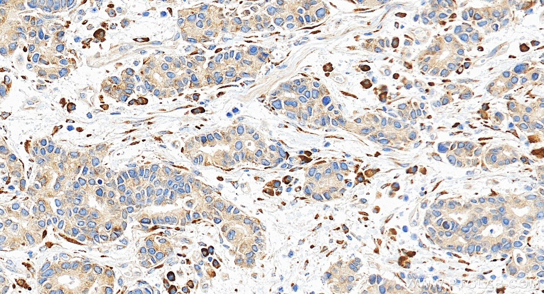 Immunohistochemical analysis of paraffin-embedded human stomach cancer tissue slide using 85374-1-RR (P4HA3 antibody) at dilution of 1:1000 (under 20x lens). Heat mediated antigen retrieval with Tris-EDTA buffer (pH 9.0). This data was developed using the same antibody clone with 85374-1-PBS in a different storage buffer formulation. Immunohistochemistry (IHC) staining of human stomach cancer tissue using P4HA3 Recombinant monoclonal antibody (85374-1-RR)
