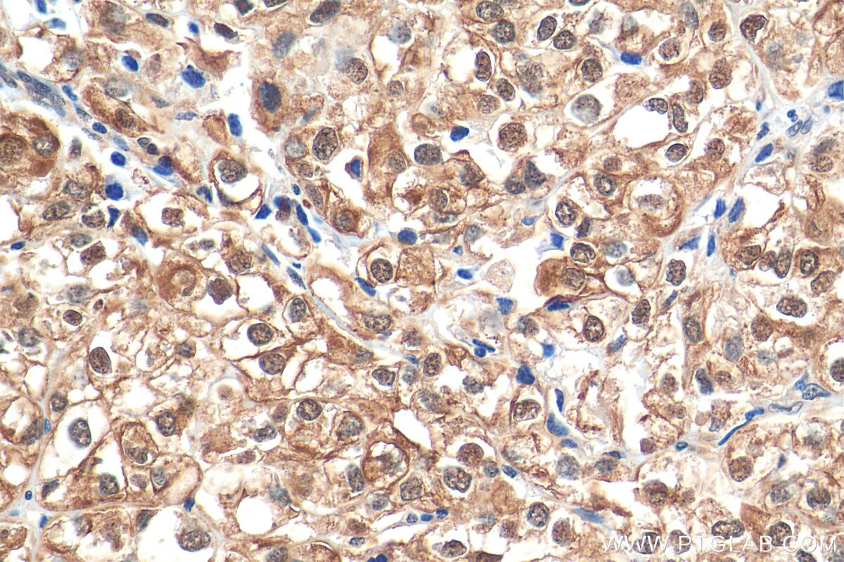 Immunohistochemistry (IHC) staining of human endometrial cancer tissue using P53 Polyclonal antibody (10442-1-AP)
