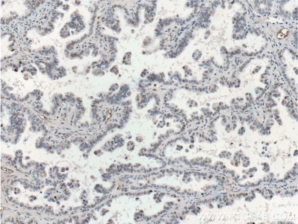 Immunohistochemistry (IHC) staining of human ovary tumor tissue using P53 Monoclonal antibody (60283-1-Ig)