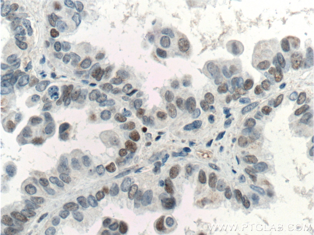 Immunohistochemistry (IHC) staining of human ovary tumor tissue using P53 Monoclonal antibody (60283-1-Ig)