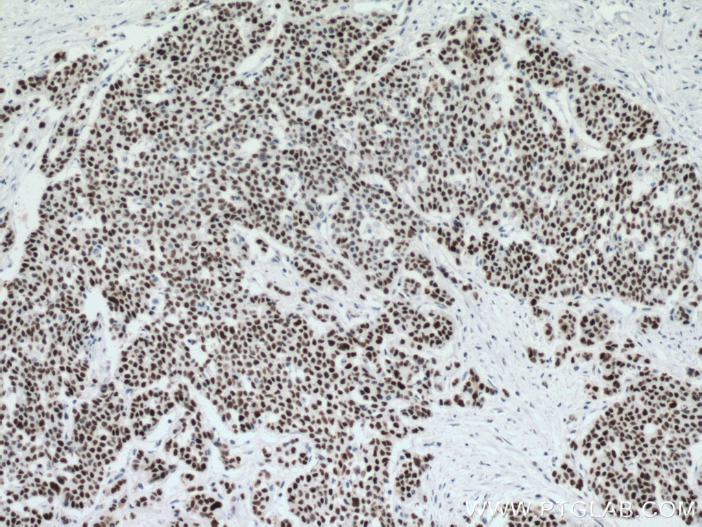 Immunohistochemistry (IHC) staining of human colon cancer tissue using P53 Monoclonal antibody (60283-2-Ig)