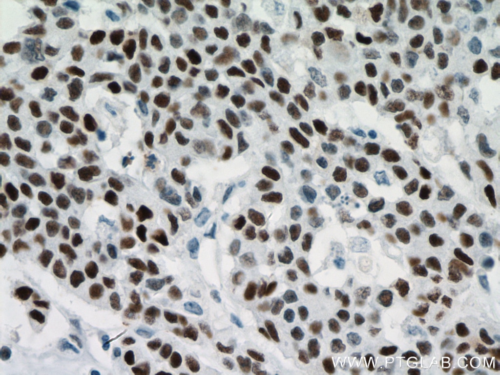 Immunohistochemistry (IHC) staining of human colon cancer tissue using P53 Monoclonal antibody (60283-2-Ig)