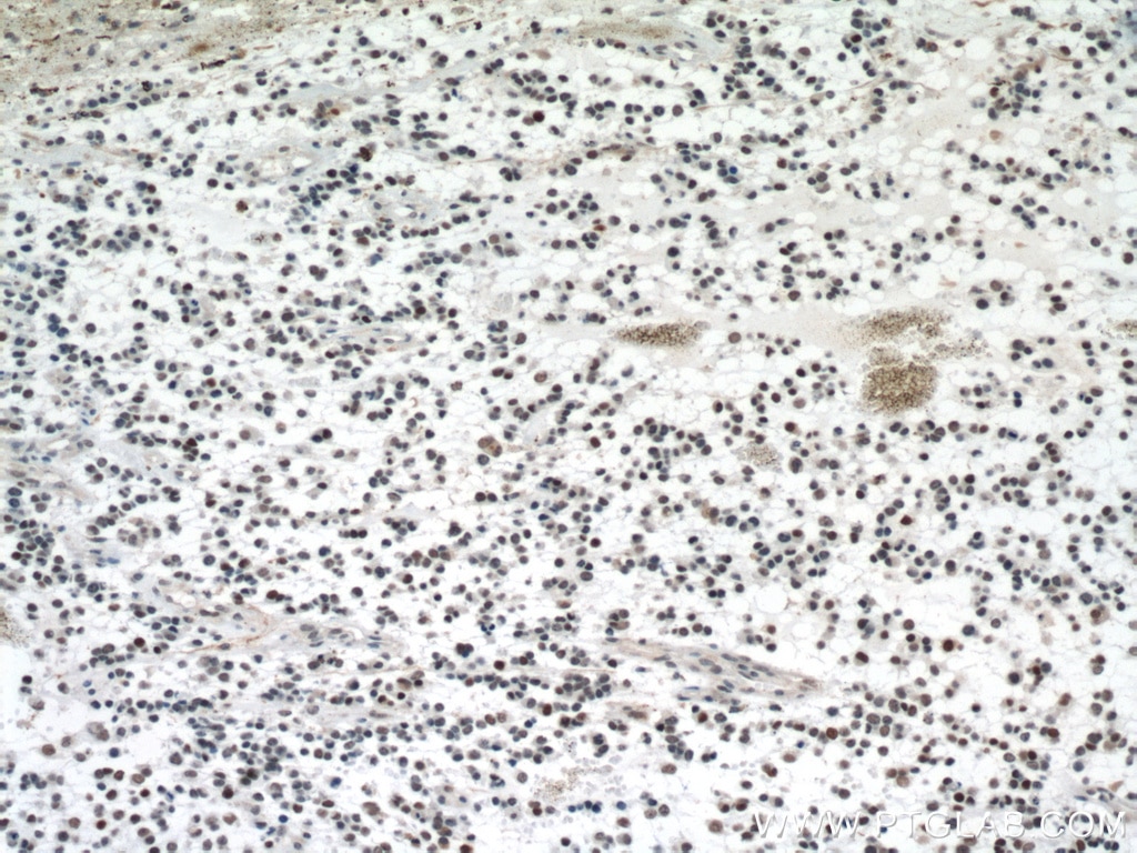 Immunohistochemistry (IHC) staining of human gliomas tissue using P53 Monoclonal antibody (60283-2-Ig)
