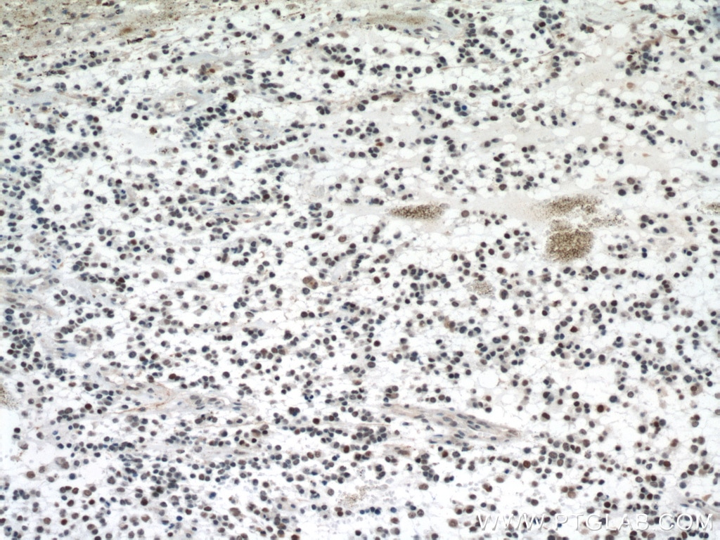 IHC staining of human gliomas using 60283-2-Ig