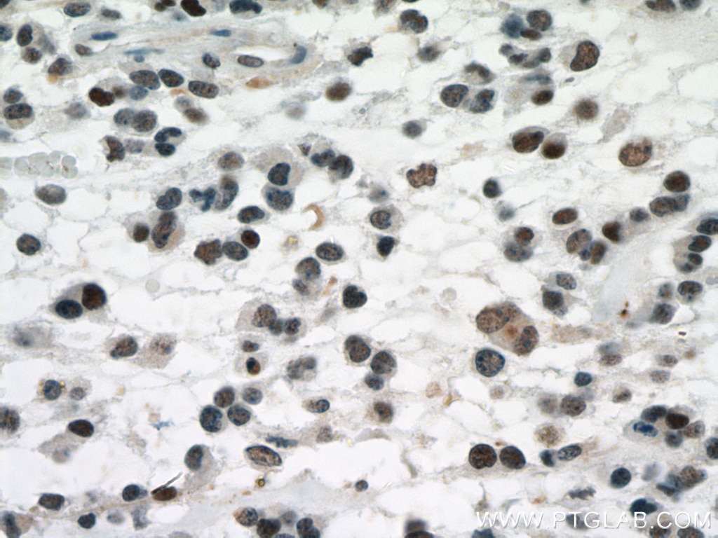 Immunohistochemistry (IHC) staining of human gliomas tissue using P53 Monoclonal antibody (60283-2-Ig)