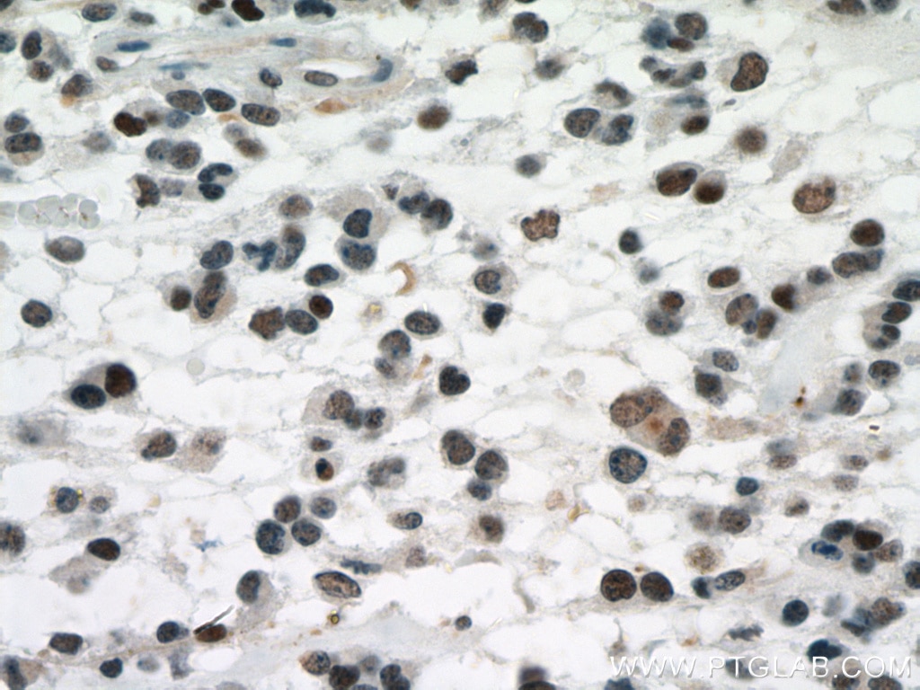 IHC staining of human gliomas using 60283-2-Ig