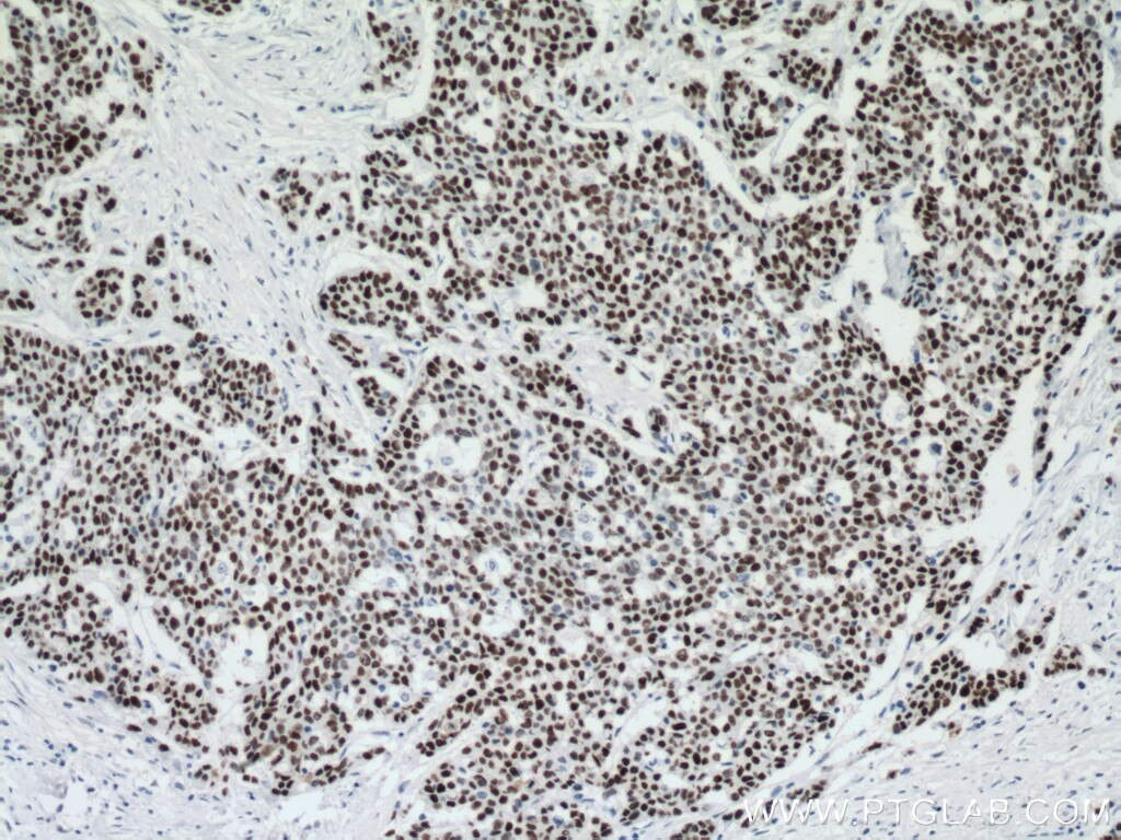 Immunohistochemistry (IHC) staining of human colon cancer tissue using P53 Monoclonal antibody (60283-2-Ig)