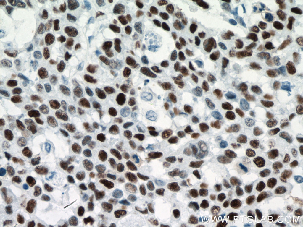 Immunohistochemistry (IHC) staining of human colon cancer tissue using P53 Monoclonal antibody (60283-2-Ig)