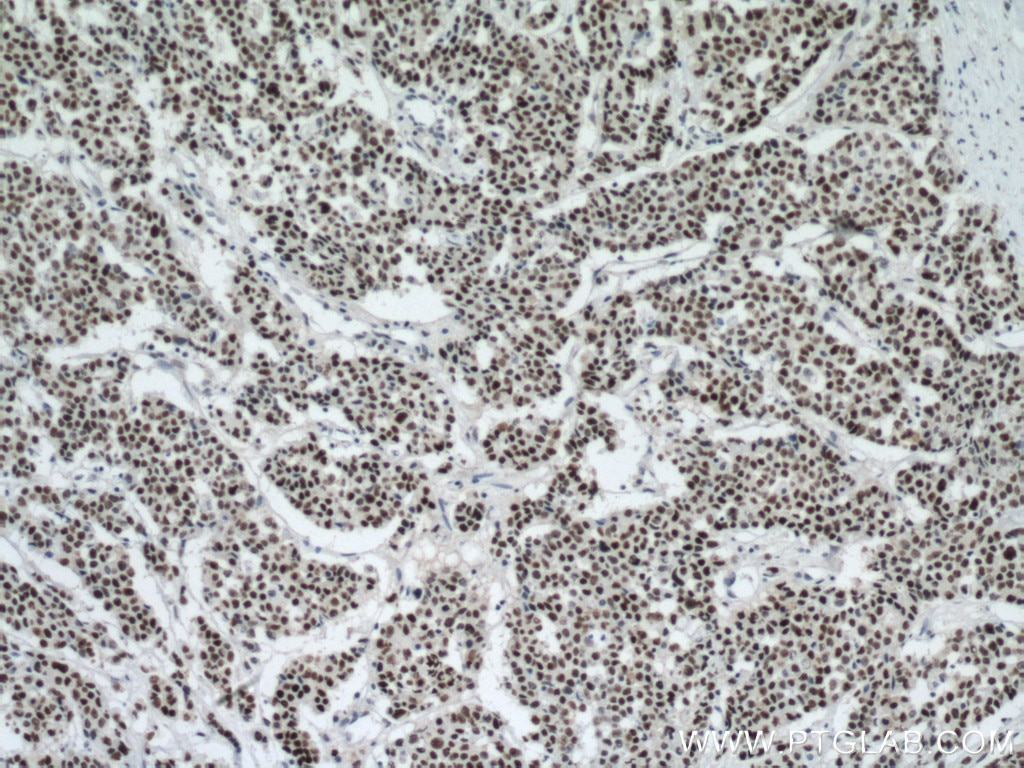 Immunohistochemistry (IHC) staining of human colon cancer tissue using P53 Monoclonal antibody (60283-2-Ig)