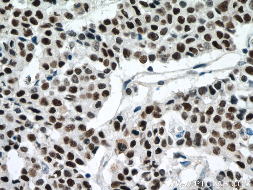 Immunohistochemistry (IHC) staining of human colon cancer tissue using P53 Monoclonal antibody (60283-2-Ig)
