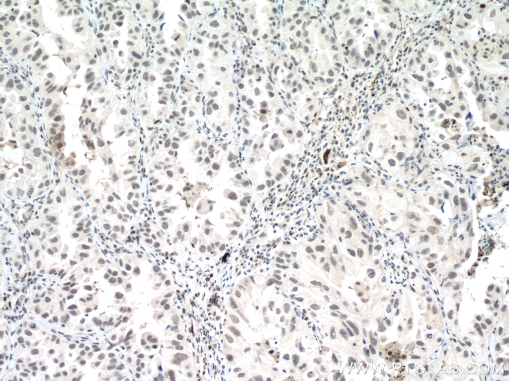 Immunohistochemistry (IHC) staining of human lung cancer tissue using P53 Monoclonal antibody (60283-2-Ig)