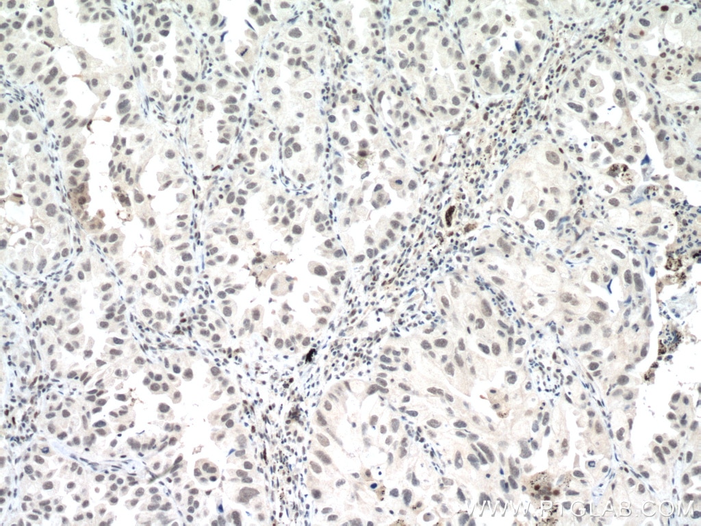 IHC staining of human lung cancer using 60283-2-Ig