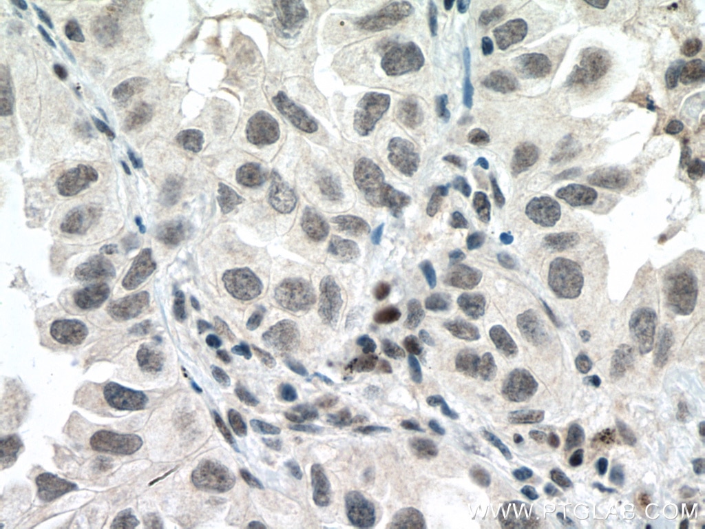 Immunohistochemistry (IHC) staining of human lung cancer tissue using P53 Monoclonal antibody (60283-2-Ig)