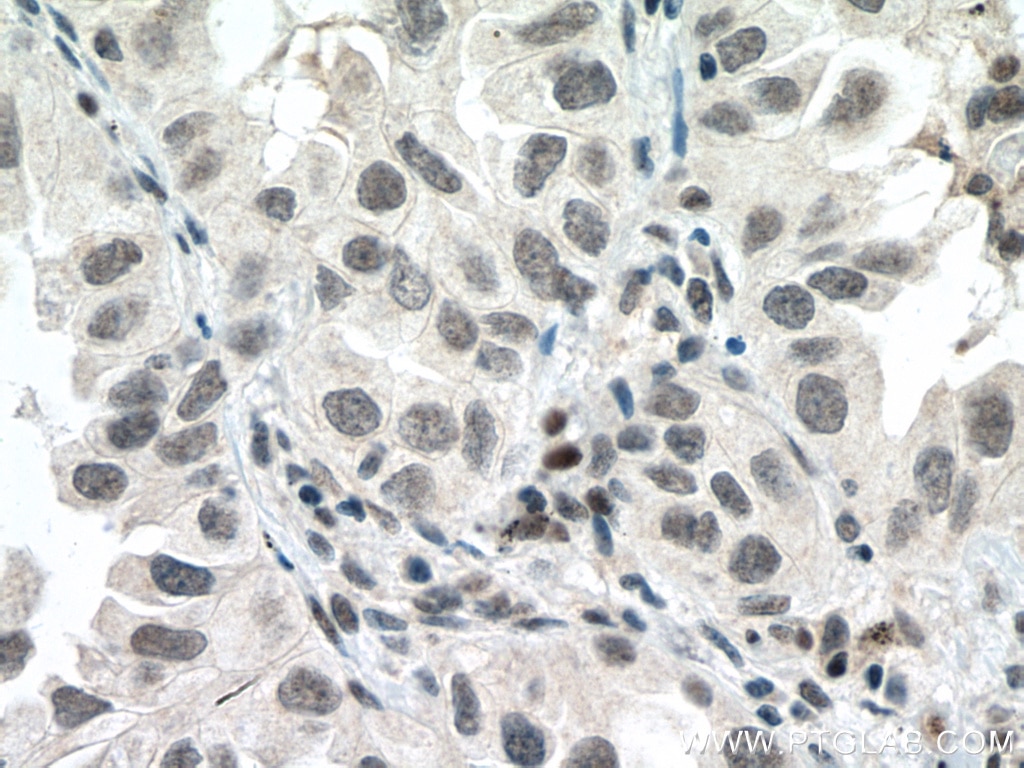 IHC staining of human lung cancer using 60283-2-Ig