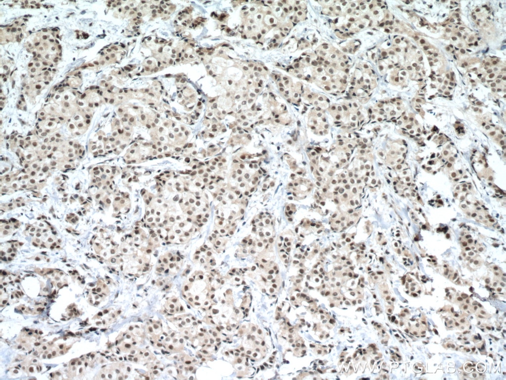Immunohistochemistry (IHC) staining of human breast cancer tissue using P53 Monoclonal antibody (60283-2-Ig)