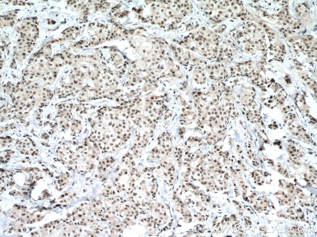 IHC staining of human breast cancer using 60283-2-Ig