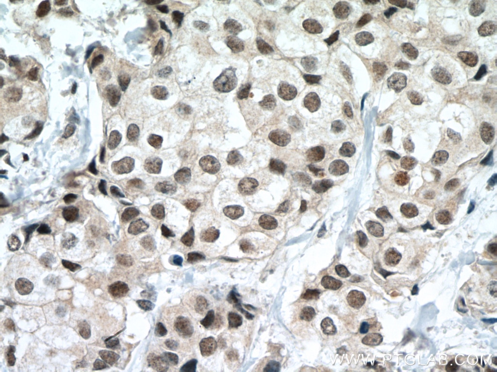 Immunohistochemistry (IHC) staining of human breast cancer tissue using P53 Monoclonal antibody (60283-2-Ig)