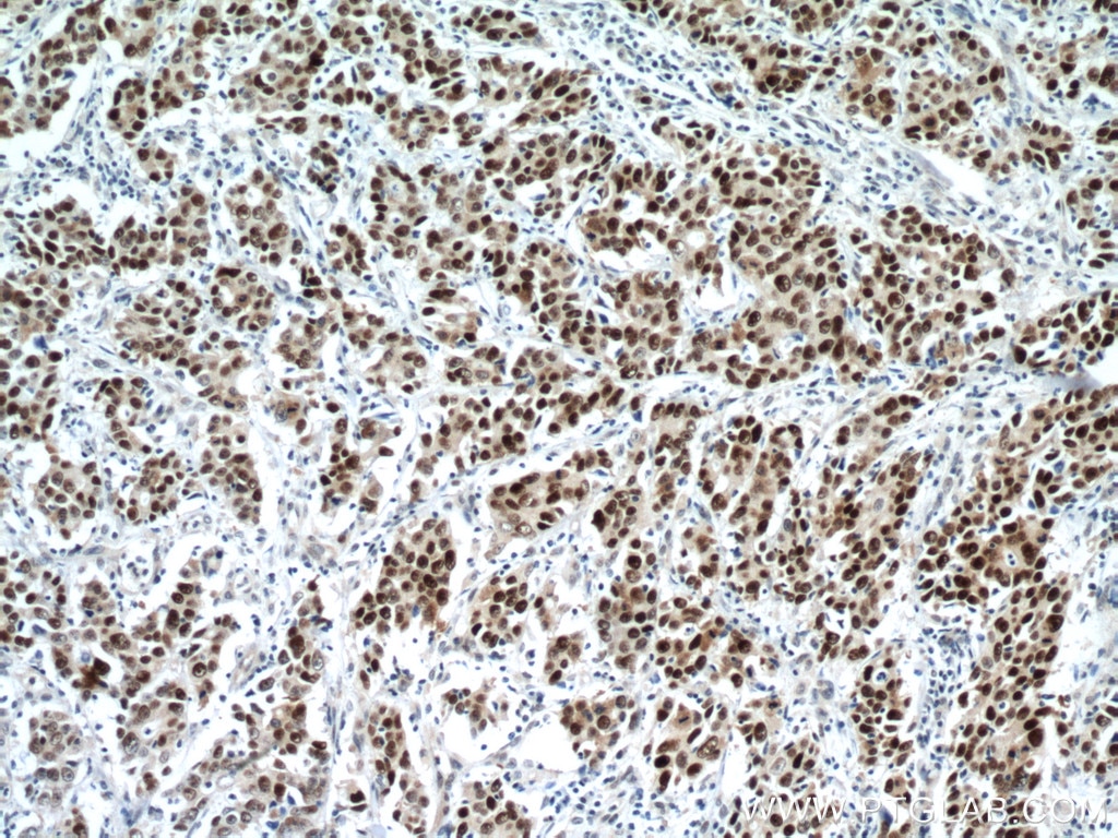 Immunohistochemistry (IHC) staining of human stomach cancer tissue using P53 Monoclonal antibody (60283-2-Ig)