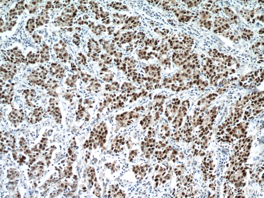 IHC staining of human stomach cancer using 60283-2-Ig