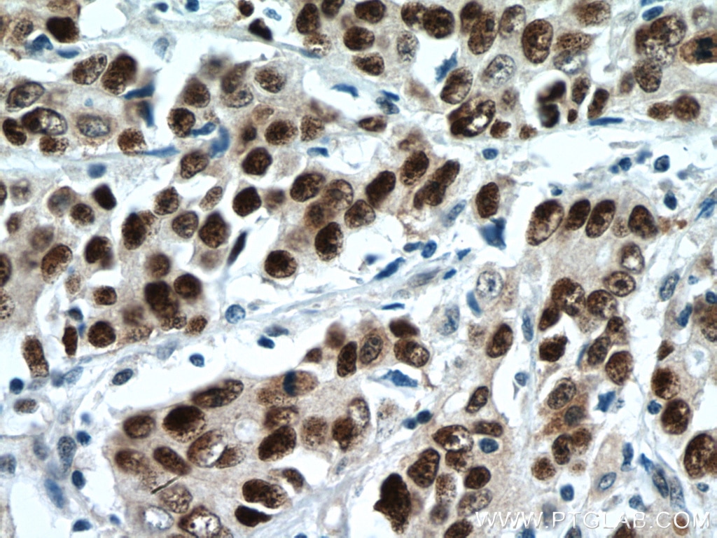 Immunohistochemistry (IHC) staining of human stomach cancer tissue using P53 Monoclonal antibody (60283-2-Ig)