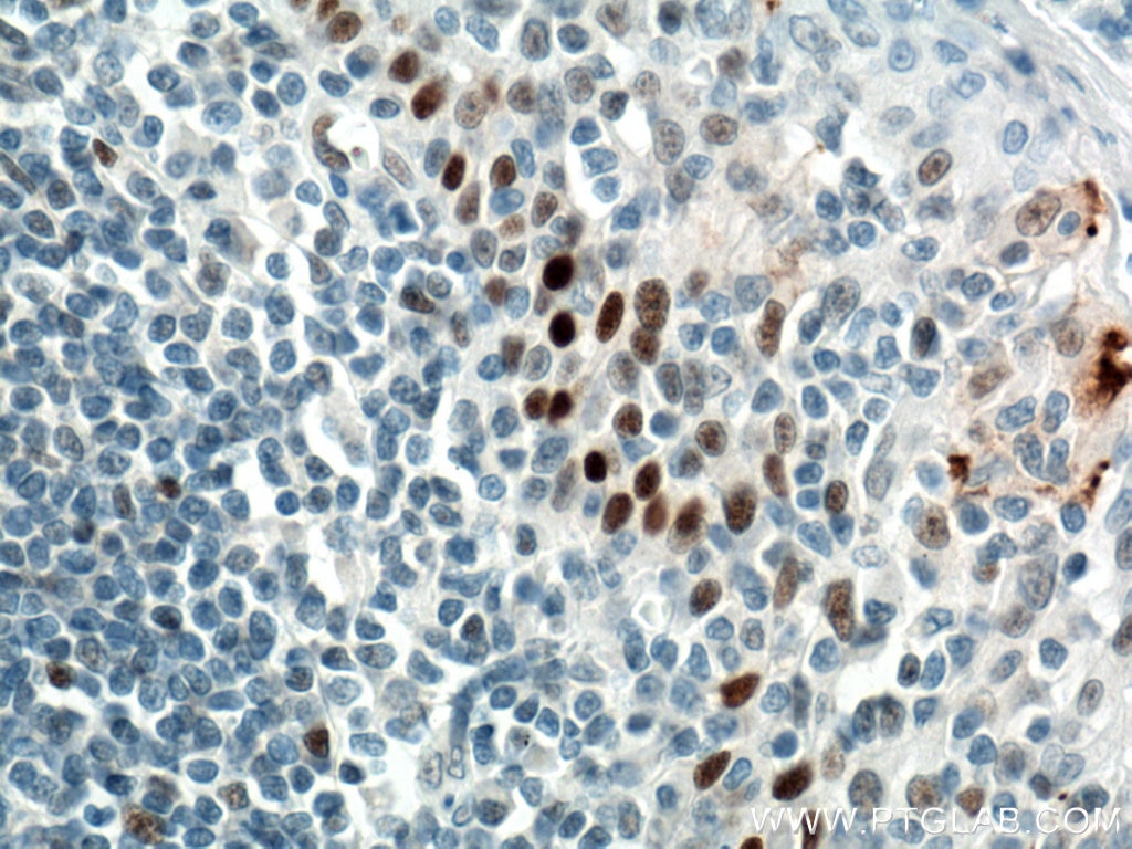 Immunohistochemistry (IHC) staining of human tonsillitis tissue using P53 Monoclonal antibody (60283-2-Ig)