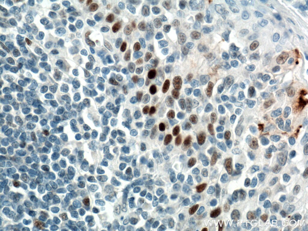 IHC staining of human tonsillitis using 60283-2-Ig