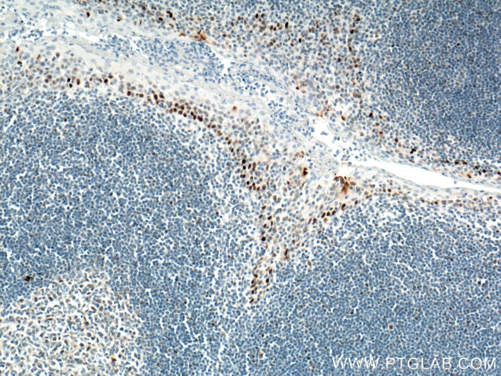 IHC staining of human tonsillitis using 60283-2-Ig